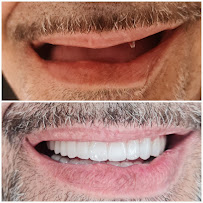 Impianti Dentali Albania - Dentisti in Albania - Oxa Clinic