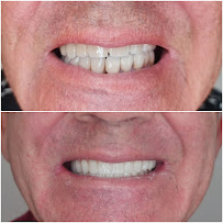 Impianti Dentali Albania - Dentisti in Albania - Oxa Clinic