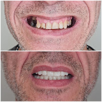 Impianti Dentali Albania - Dentisti in Albania - Oxa Clinic