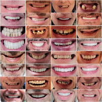 Impianti Dentali Albania - Dentisti in Albania - Oxa Clinic in Tirana