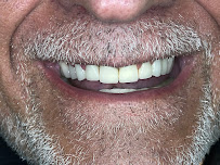 Max Dent - Klinikë dentare, Dental Clinic in Albania, Dental Tourism Albania