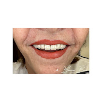 BLERINA DENT Vollga - Dr. Blerina Bani Topra - Dentist Durres ,Albania Pro Implants & Aesthetic Dentistry