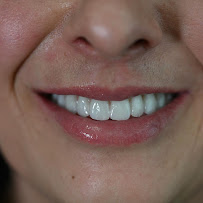 BLERINA DENT Vollga - Dr. Blerina Bani Topra - Dentist Durres ,Albania Pro Implants & Aesthetic Dentistry