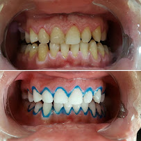 BLERINA DENT Vollga - Dr. Blerina Bani Topra - Dentist Durres ,Albania Pro Implants & Aesthetic Dentistry