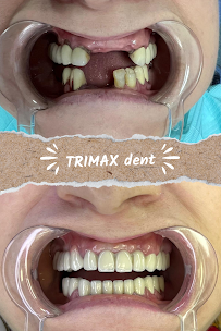 TRIMAX DENT