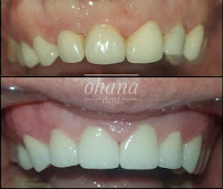 Ohana Dent