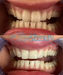 Laserowe Wybielanie Zębów White Beauty w Krakowie