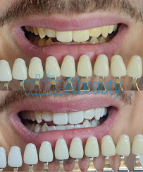Laserowe Wybielanie Zębów White Beauty w Krakowie