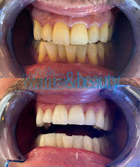 Laserowe Wybielanie Zębów White Beauty w Krakowie