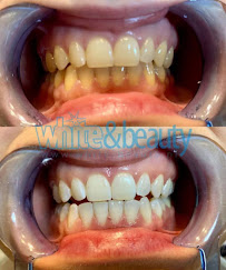 Laserowe Wybielanie Zębów White Beauty w Krakowie