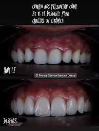 Clínica dental FRANCA SONRISA/Diseño de sonrisa/Resinas/Muelas del juicio/Brackets/Alineadores/odontopediatria/