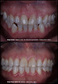 Clínica dental FRANCA SONRISA/Diseño de sonrisa/Resinas/Muelas del juicio/Brackets/Alineadores/odontopediatria/