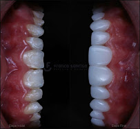Clínica dental FRANCA SONRISA/Diseño de sonrisa/Resinas/Muelas del juicio/Brackets/Alineadores/odontopediatria/