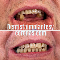 Dentista general coronas e implantes dentales