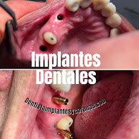 Dentista general coronas e implantes dentales