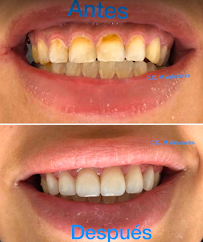Dentista general coronas e implantes dentales