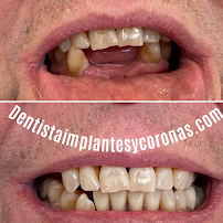 Dentista general coronas e implantes dentales