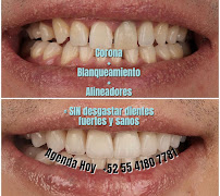 Dentista general coronas e implantes dentales