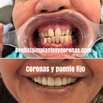 Dentista general coronas e implantes dentales