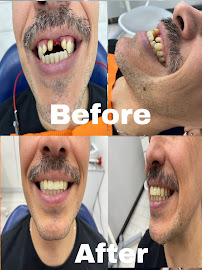 Dentista general coronas e implantes dentales