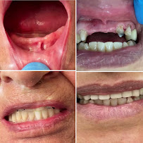 Dentista general coronas e implantes dentales