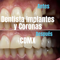 Dentista general coronas e implantes dentales