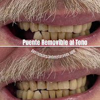 Dentista general coronas e implantes dentales