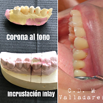 Dentista general coronas e implantes dentales