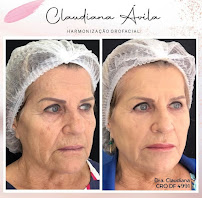 Clínica Ávila - Harmonização Facial - Odontologia - Prótese Dentária - Asa Sul - Brasília - DF