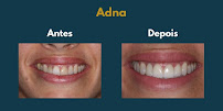 Dra. Talita Chimeli 🏅- Faceta de Porcelana - Lente de contato - Odontologia Estética e Funcional
