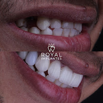 Royal Implantes