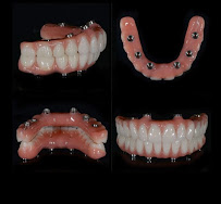 Royal Implantes