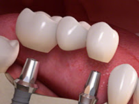 Dentista Tatiana Mendes Ortodontista, Implantes Dentários I Aparelho transparente I Aparelho ortodôntico I Salvador