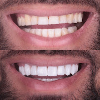 Dentista Rafaela Lopes - Lente de Contato Dental em Salvador - Lentes de Resina Valor facetas