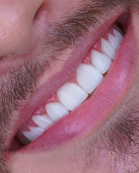 Dentista Rafaela Lopes - Lente de Contato Dental em Salvador - Lentes de Resina Valor facetas