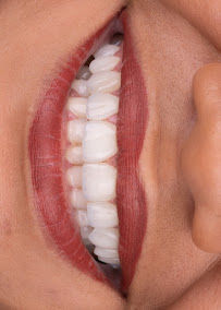 Dentista Rafaela Lopes - Lente de Contato Dental em Salvador - Lentes de Resina Valor facetas