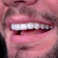 Dentista Rafaela Lopes - Lente de Contato Dental em Salvador - Lentes de Resina Valor facetas