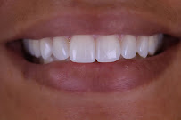Dentista Rafaela Lopes - Lente de Contato Dental em Salvador - Lentes de Resina Valor facetas