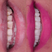Dentista Rafaela Lopes - Lente de Contato Dental em Salvador - Lentes de Resina Valor facetas