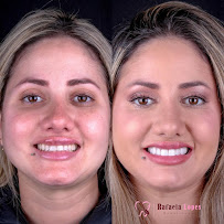 Dentista Rafaela Lopes - Lente de Contato Dental em Salvador - Lentes de Resina Valor facetas
