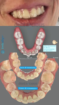 Ortodoncia Invisible | Dentalicious