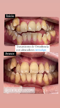 Ortodoncia Invisible | Dentalicious