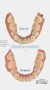 Ortodoncia Invisible | Dentalicious