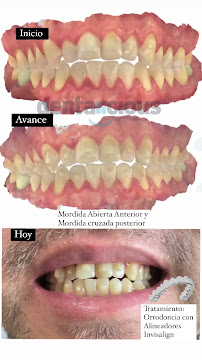 Ortodoncia Invisible | Dentalicious