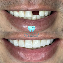 Dentista em Fortaleza - CE | Clínica Odontológica | Exclusiva Odontologia | Implante Dentário