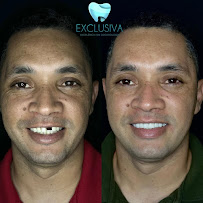 Dentista em Fortaleza - CE | Clínica Odontológica | Exclusiva Odontologia | Implante Dentário