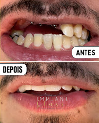 Implant Class