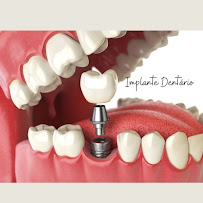 Implant Class