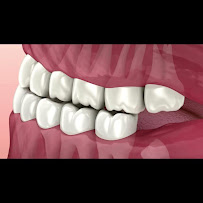 Implant Class