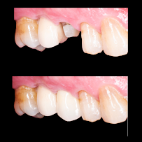Implant Class